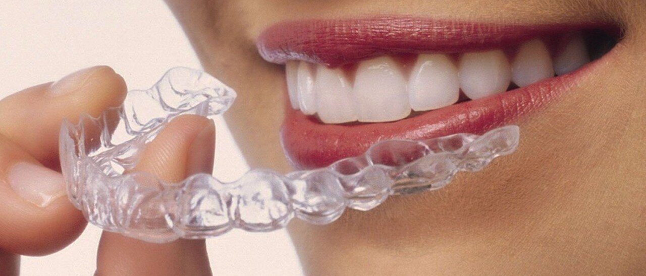 Aligners van Invisalign