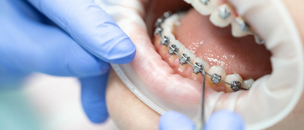 Orthodontie voor alle leeftijden!