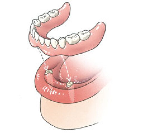 overkappingsprothese op bestaande wortels of implantaten